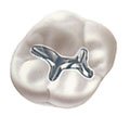 Amalgam Dolgu